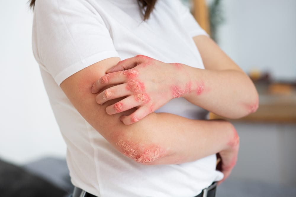 Yellow Fungus Symptoms Skin Problems