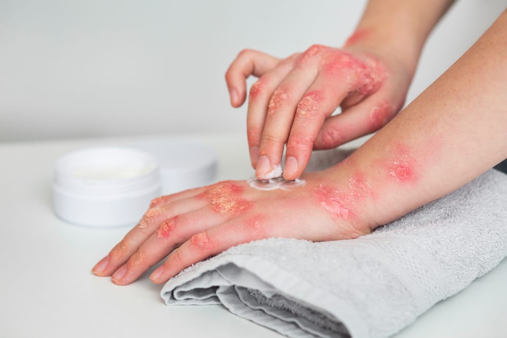 Skin Lesions
