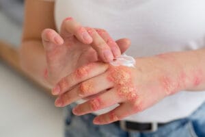 Read more about the article Yellow Fungus Symptoms and How to Spot Them Early