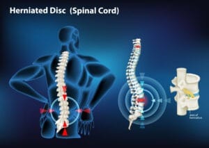 Read more about the article PIVD Symptoms: How to Identify and Manage Back Pain