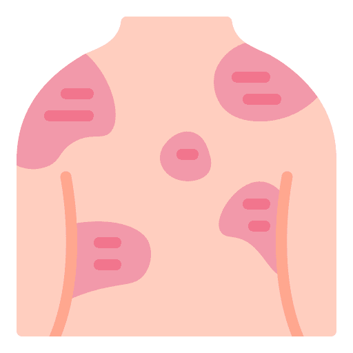 eczema skin treatment in hulsoor